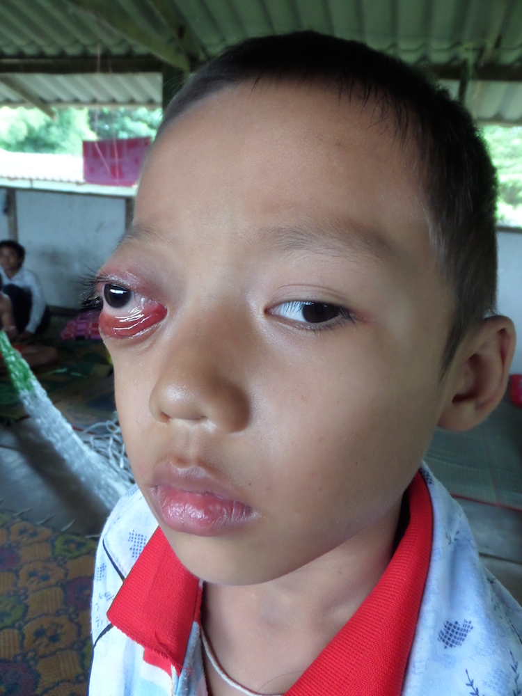 tell his mother anything further about his condition. Instead, he simply advised her that she should take him to Rangoon soon to have eye surgery. - Aung-Myint-Myat_M7y_Eye-tumor_PreOp-6