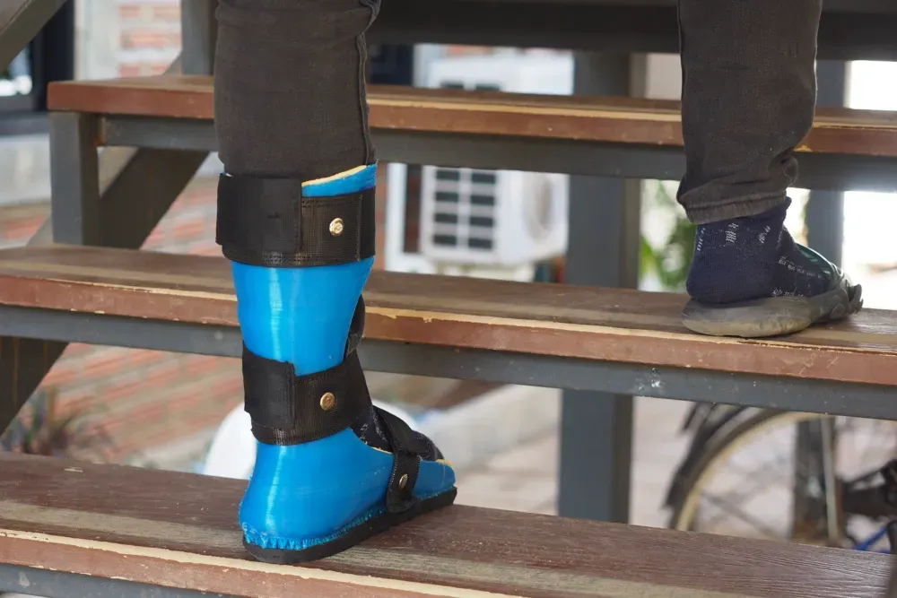 3D printed ankle-foot orthosis 3