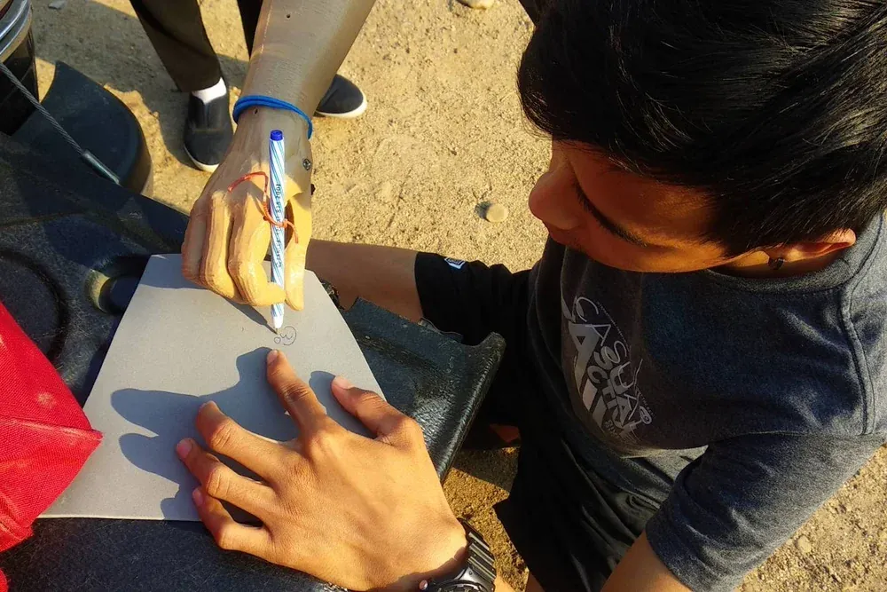 3D printed prosthetic-arm orthosis 3