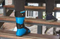 3D printed ankle-foot orthosis 3