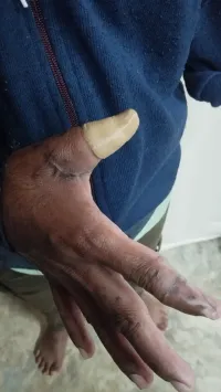 3D printed cosmetic-hand orthosis 3