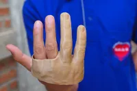3D printed cosmetic-hand orthosis 5