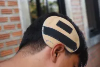 3D printed external-cranial-plate orthosis 1