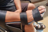 3D printed orthosis 10