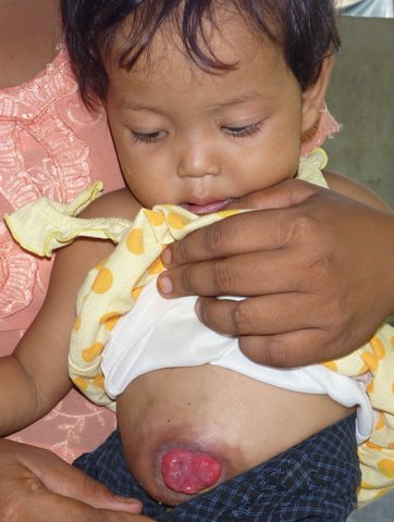 2-year-old Nway with her colostomy