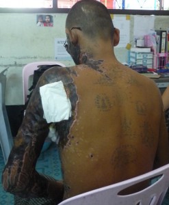 1-121017_BAMF_Aung_M34_burn victim (14)