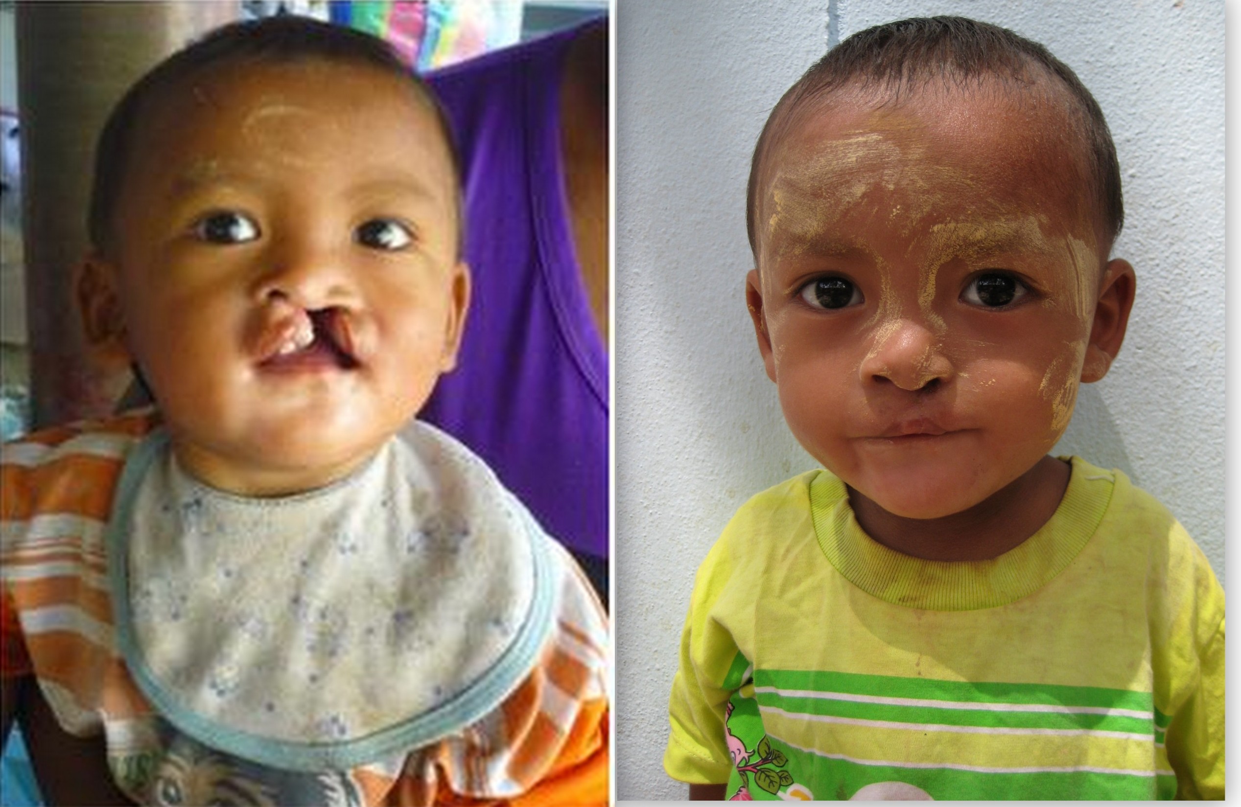 Before and after photos of two year old Ing Gha Htoo
